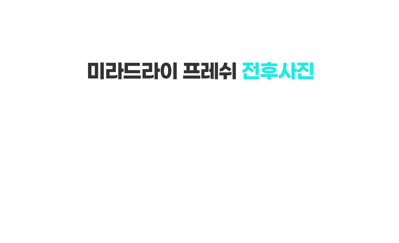 스타피부과 다한증 미라드라이 프레쉬