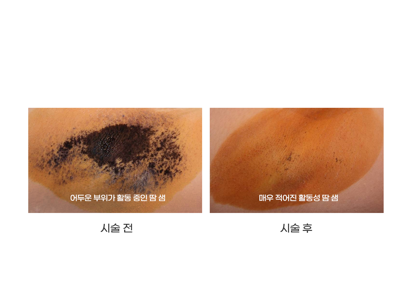 스타피부과 다한증 미라드라이 프레쉬